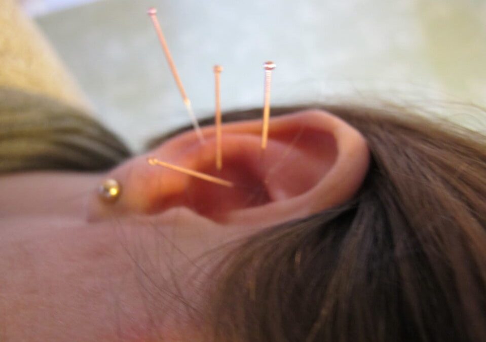 Har du testat akupunktur?